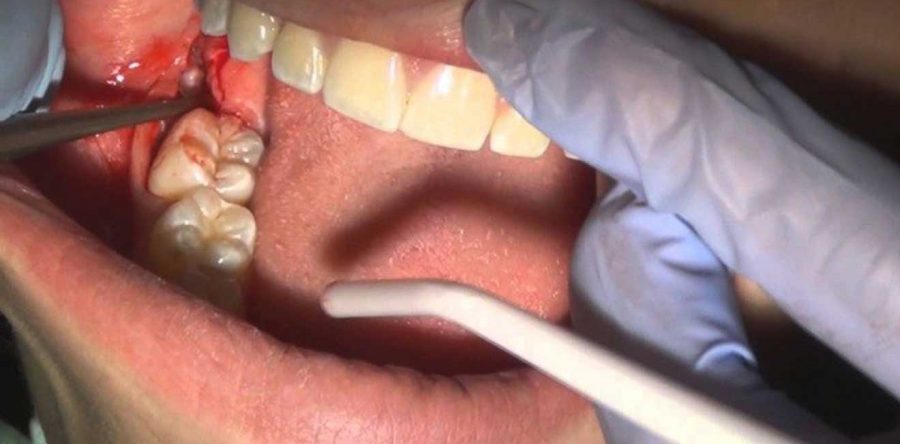 کشیدن دندان های عقل برای درمان ارتودنسی